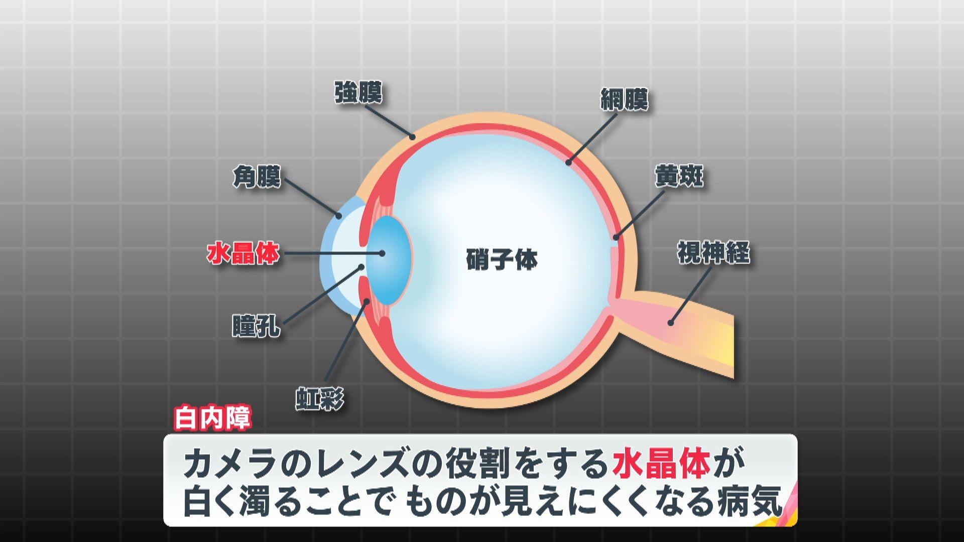 め8白内障 (7)