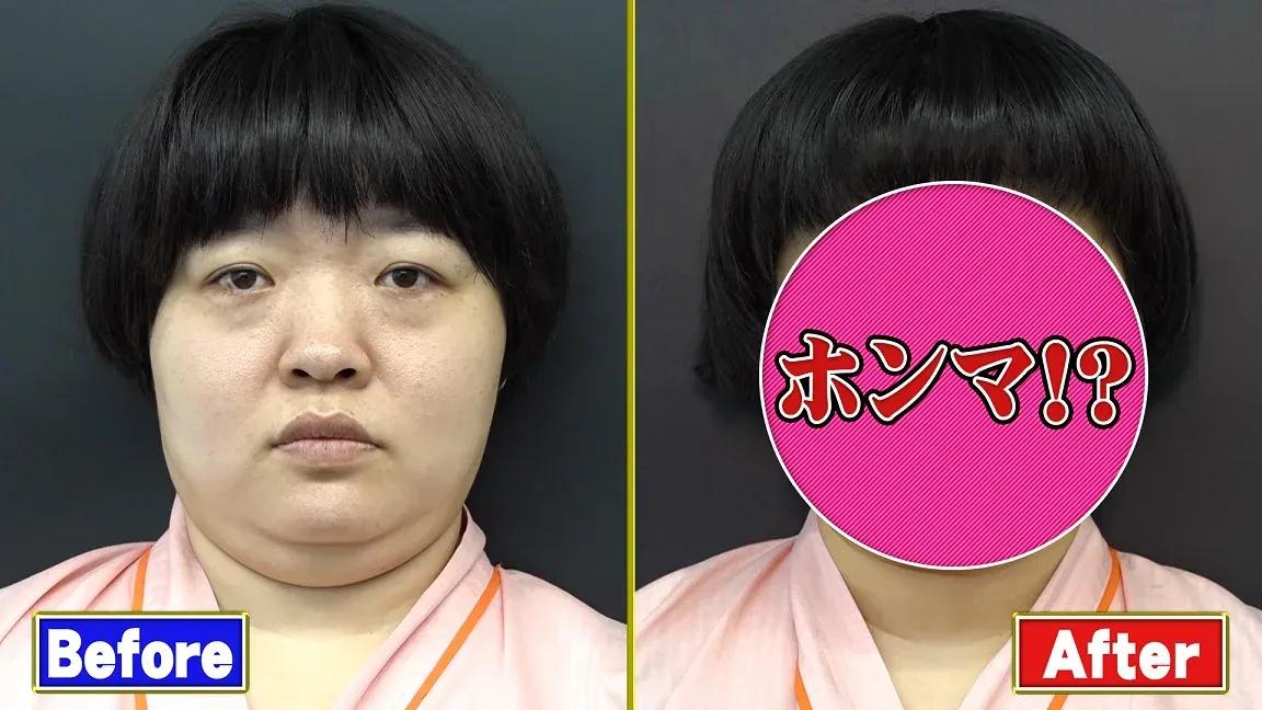 りんたろー。、オカリナ、磯野貴理子が 最新美容整形法「ハイフ」に挑戦！その効果は？_bodies