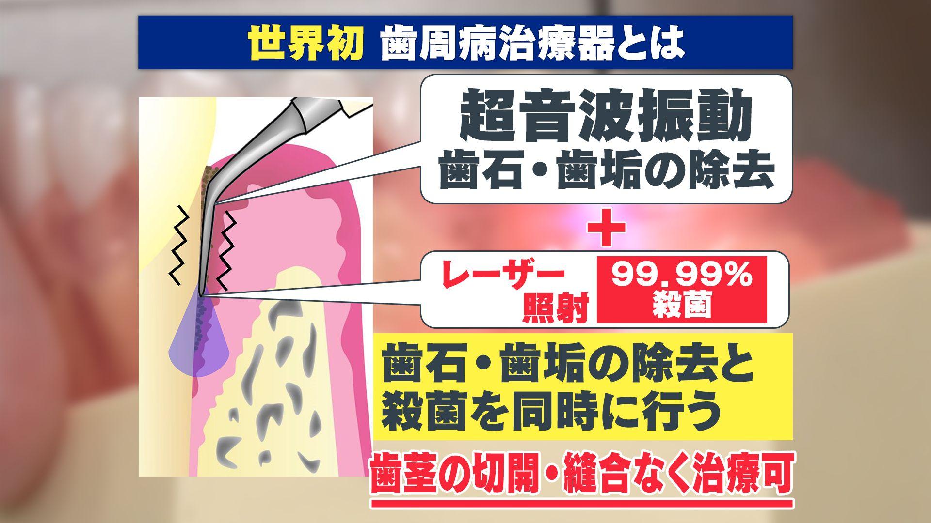 【世界初】「歯周病」の治療器が日本で承認　99.99％殺菌！？ お値段は？効果は？痛みは？気になる疑問全部答えます