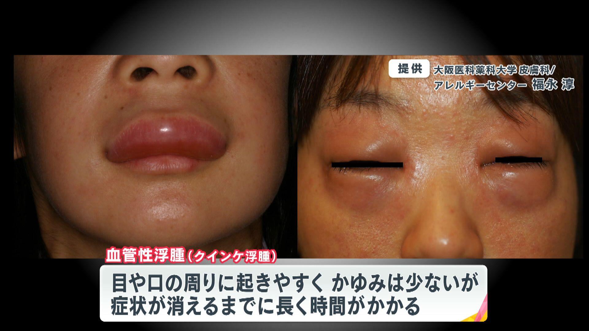 め８　血管性浮腫　症状