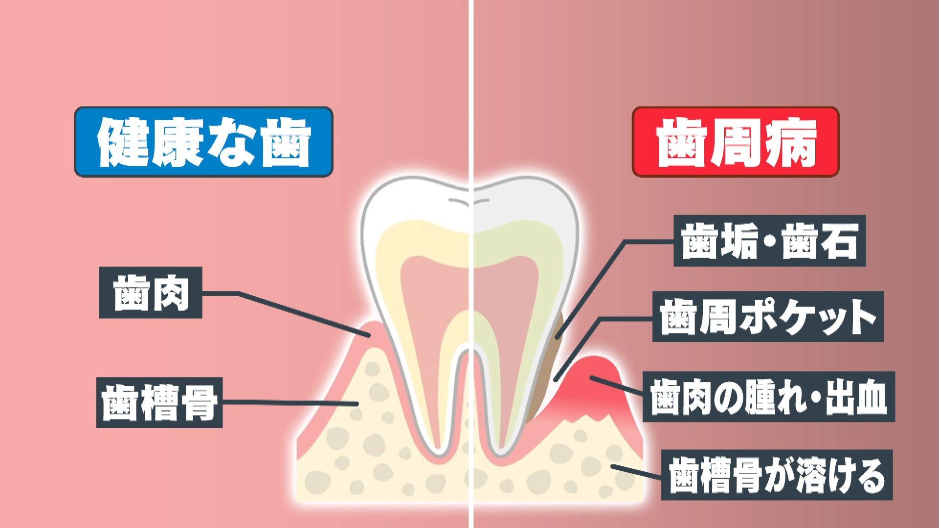 め8歯周病14